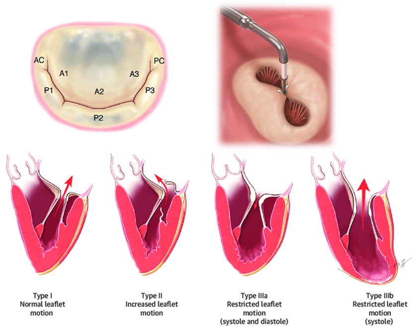 Peijia Medical Successfully Commenced Animal Study for its Mitral Valve Edge-to-Edge Repair Product