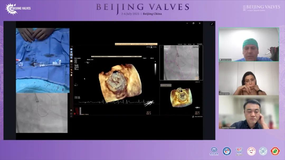 Peijia Medical Showcased Innovative Portfolio  at Beijing Valves 2025