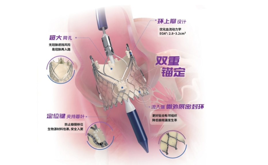 交汇点：苏企创新产品获批上市 让治疗主动脉瓣反流创伤更小